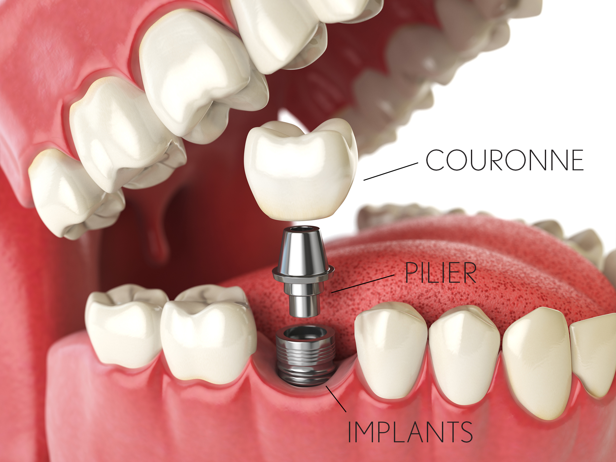 Implants dentaires : tout ce qu’il faut savoir