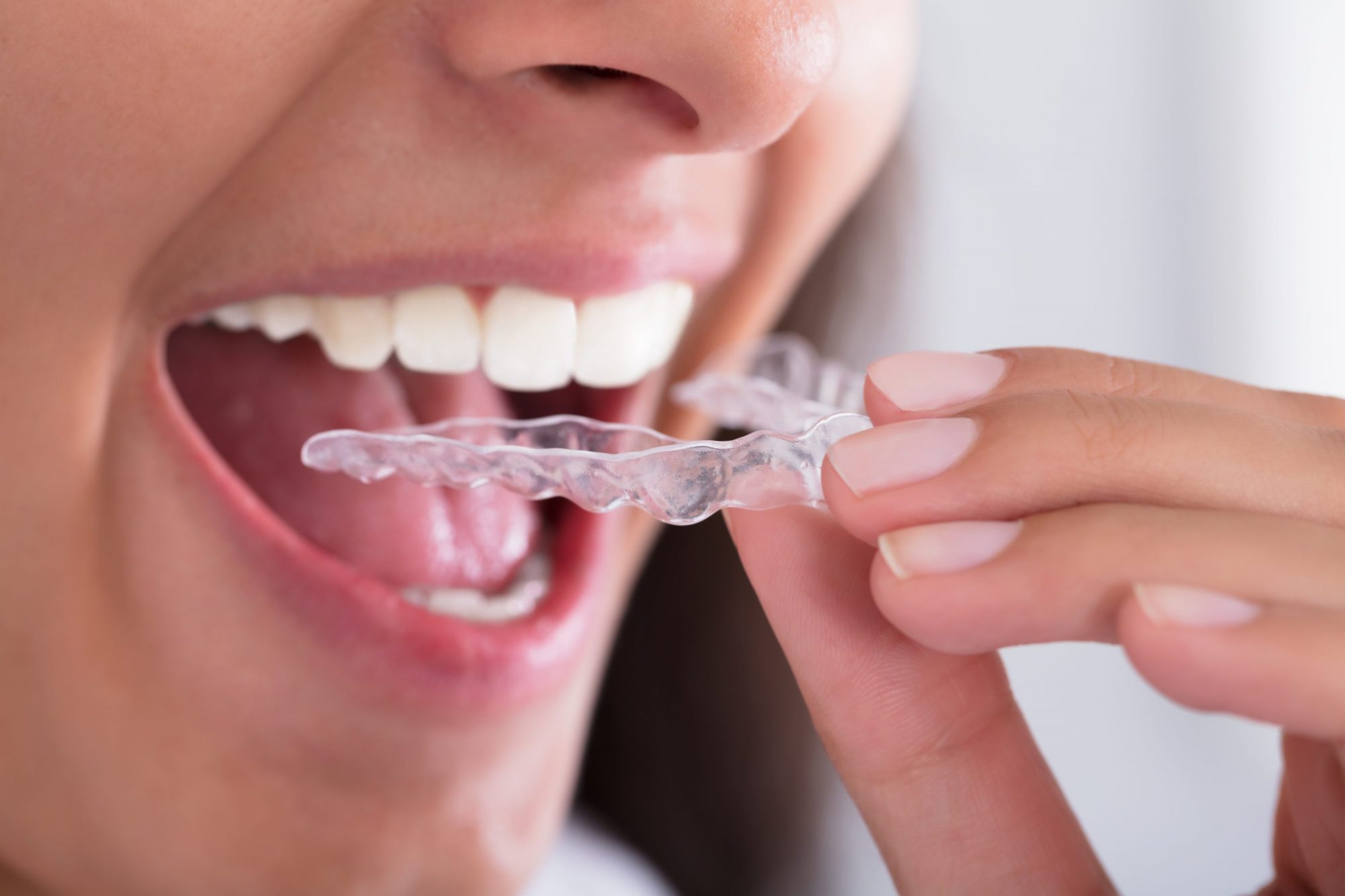 Bruxisme — Comment grincer des dents affecte votre santé buccodentaire